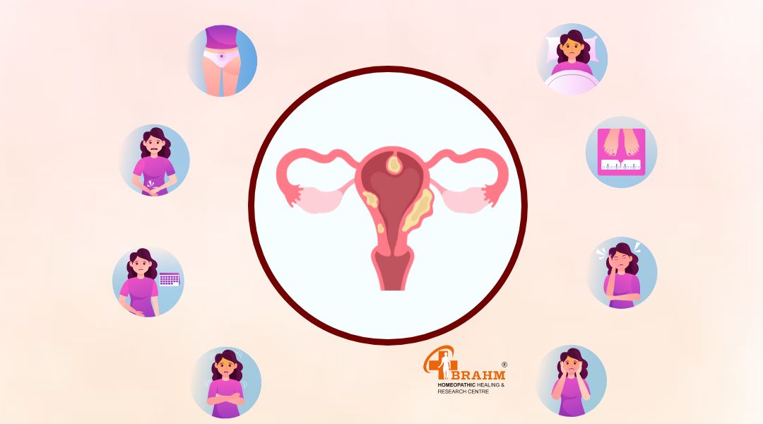 Features of Uterine Fibroids